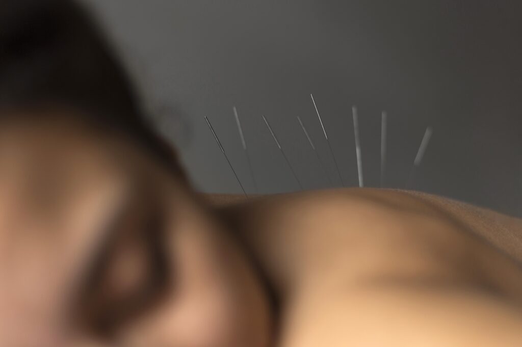 ฝังเข็ม Dry Needling แก้ปวด คลายกล้ามเนื้อ ออฟฟิศซินโดรม